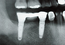 Total Implant Bridge