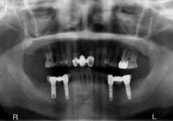 Implant Bridge After