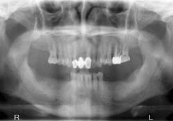 Implant Bridge Before