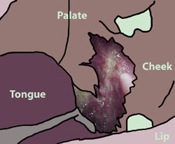 Squamous Carcinoma