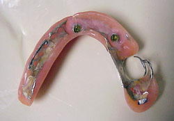 Denture Appliance