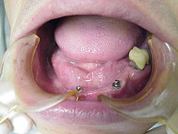 Attachment for Dentures