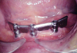 Denture Attachment