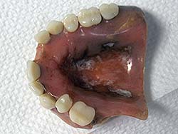 Dirty Denture Bottom