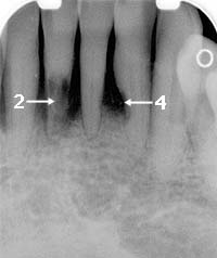 Resorption After