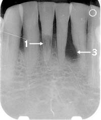 Resorption Before