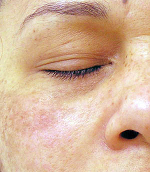 Hydrafacial After