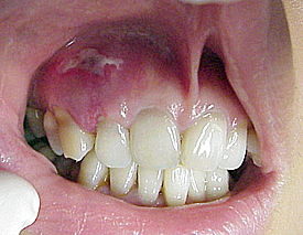 Gum Defect After