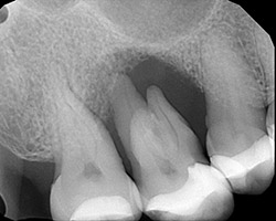 Bone Graft Before