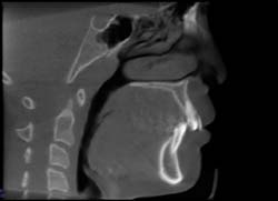 Airway Before