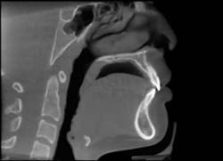 Airway After