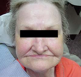 Dentures Before Face